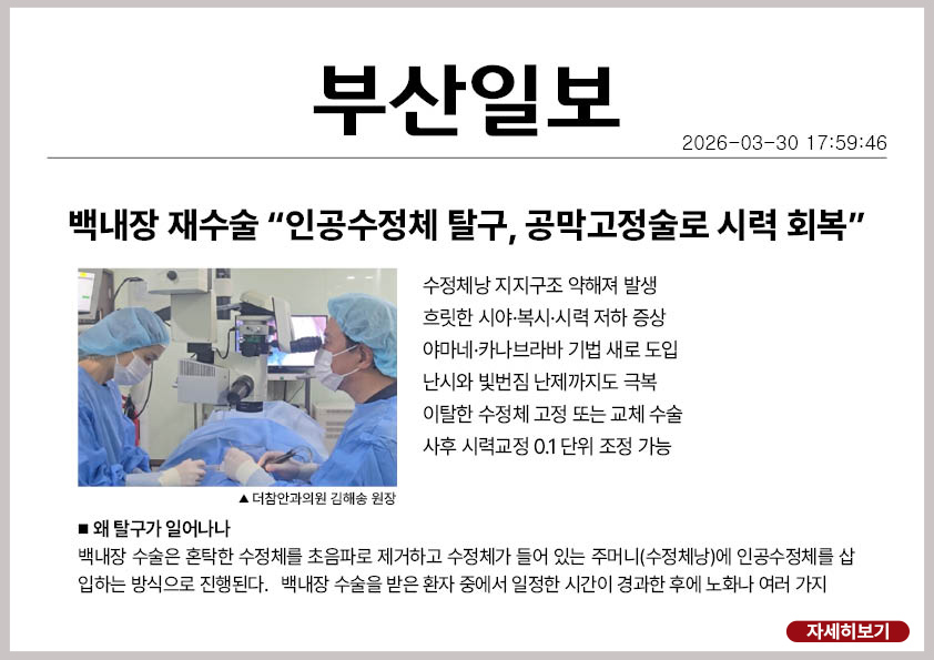 부산일보 인공수정체탈구,백내장재수술,공막고정술,야마네기법,카나브라바,백내장재수술후기