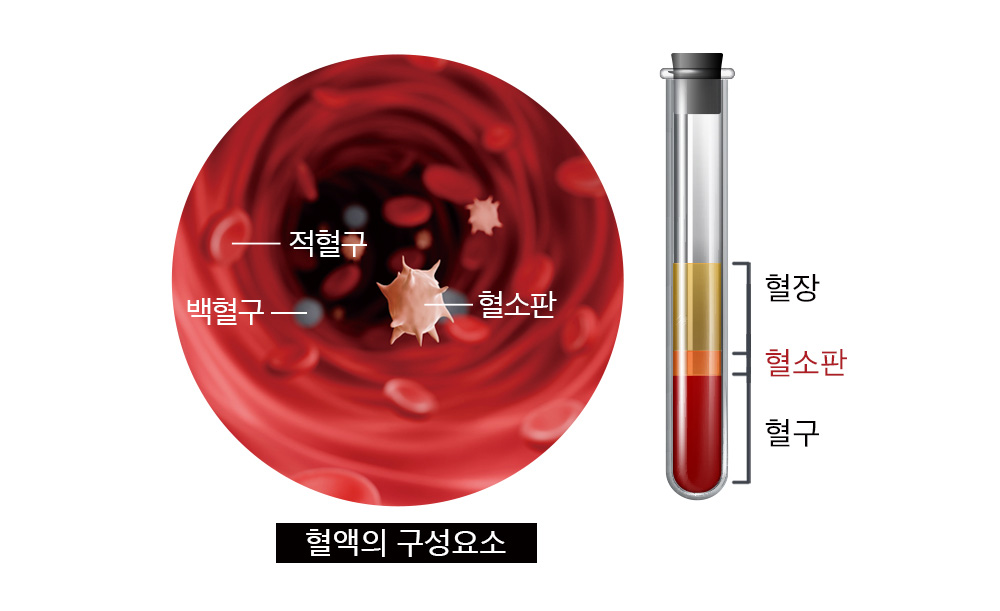 라식, 백내장 등 안과수술 후 빠른회복과 심한 안구건조증의 치료에 효과적 - 자가혈청[PRP] 안약치료-더참안과